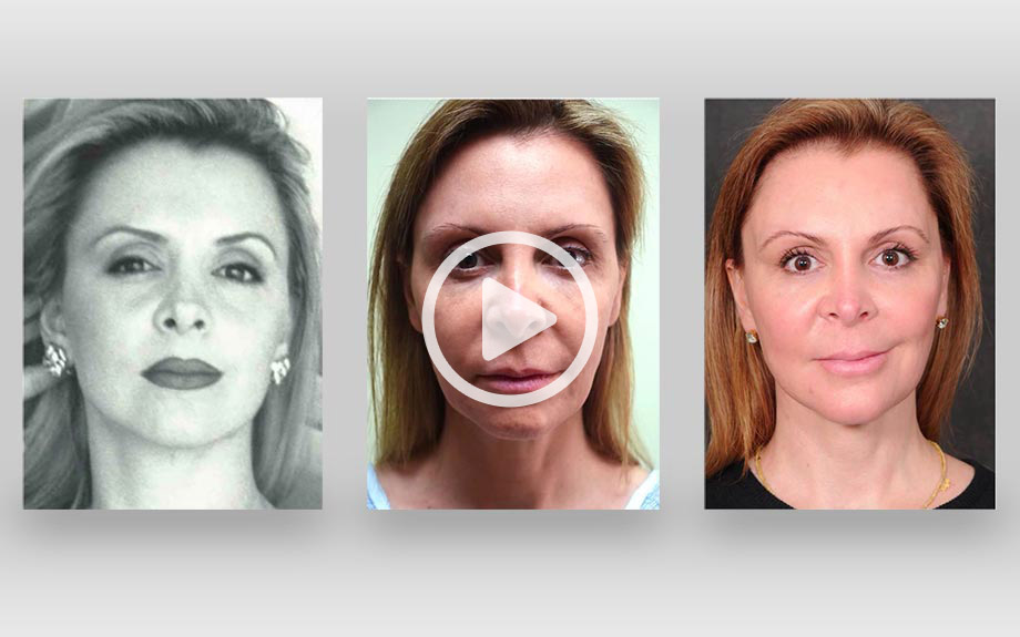 Ponytail Facelift On Oprah | ponytail facelift on oprah facelift los angeles ca kao Ponytail Facelift On Oprah | ponytail facelift on oprah facelift los angeles ca kao