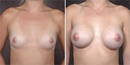 View Breast Before & After Photos