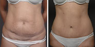 View Body Before & After Photos