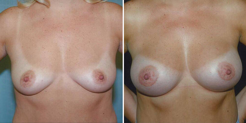 Dr. Kao Breast Augmentation