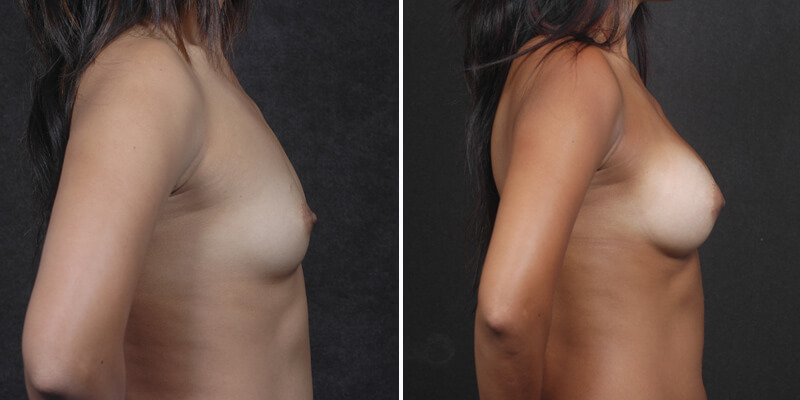 Dr. Kao Breast Augmentation