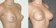 Dr. Kao Breast Augmentation