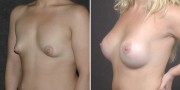 Dr. Kao Breast Augmentation