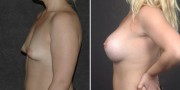 Dr. Kao Breast Augmentation