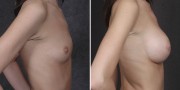 Dr. Kao Breast Augmentation