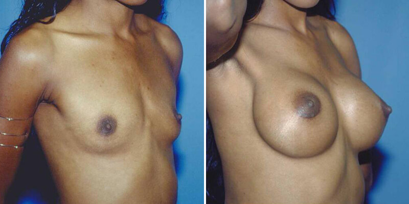 Dr. Kao Breast Augmentation