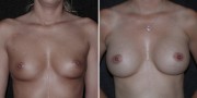 Dr. Kao Breast Augmentation