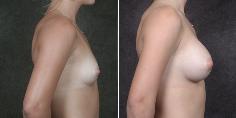 breast augmentation before and after