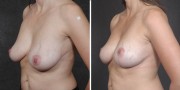 Dr. Kao Breast Lift