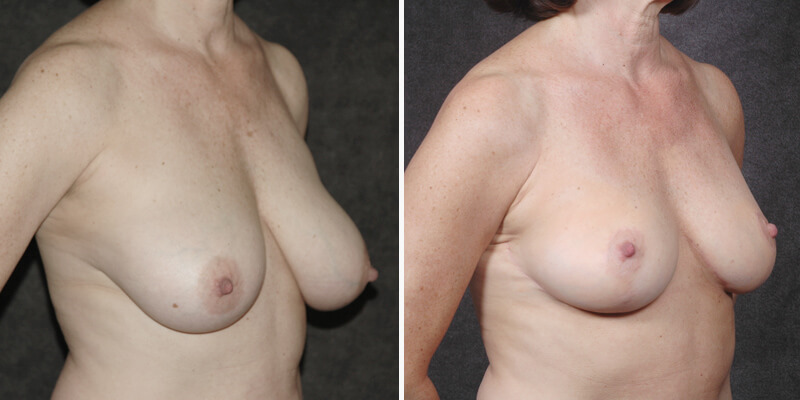 Dr. Kao Breast Lift