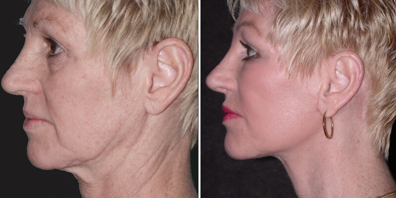 Dr. Kao Ponytail Facelift