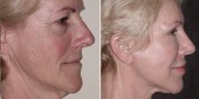 Dr. Kao Ponytail Facelift