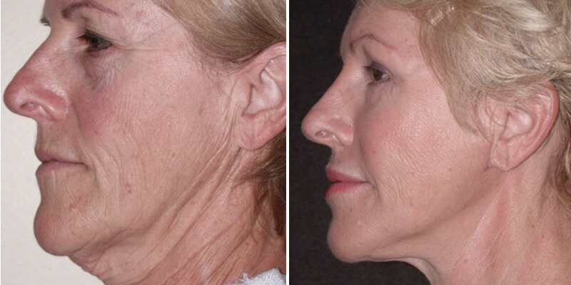 Dr. Kao Ponytail Facelift