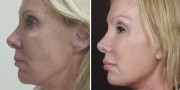 Dr. Kao Ponytail Facelift