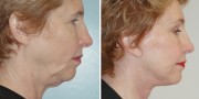 Dr. Kao Ponytail Facelift