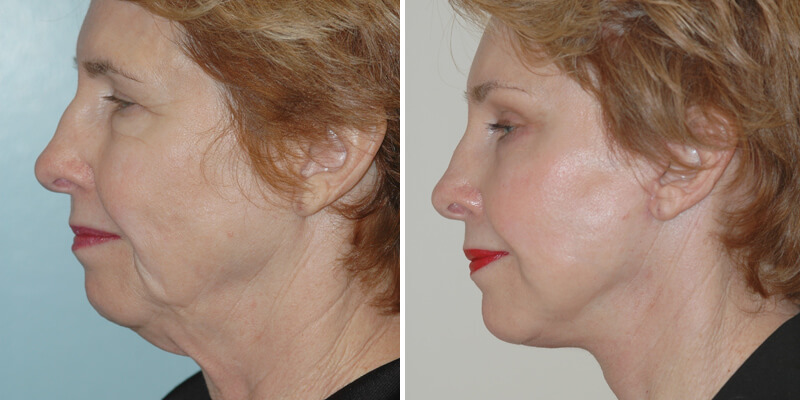 Dr. Kao Ponytail Facelift