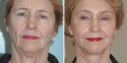 Dr. Kao Ponytail Facelift