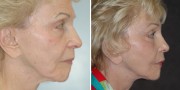 Dr. Kao Ponytail Facelift