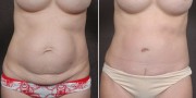 Dr. Kao Tummy Tuck (Abdominoplasty)