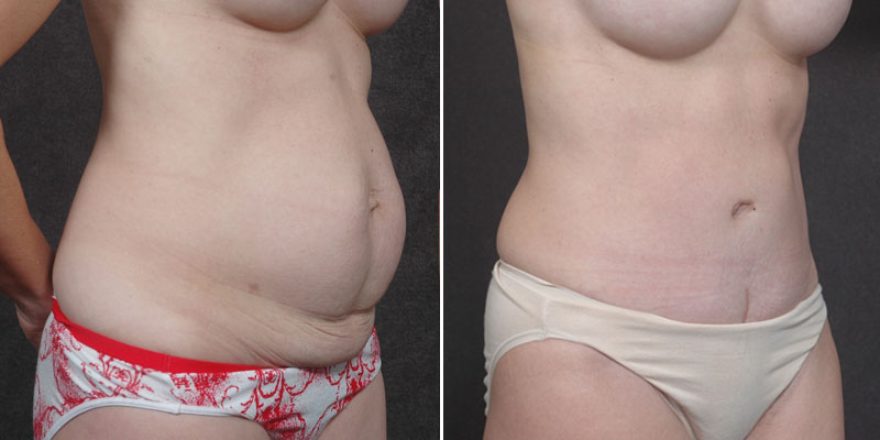 Dr. Kao Tummy Tuck (Abdominoplasty)