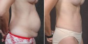 Dr. Kao Tummy Tuck (Abdominoplasty)