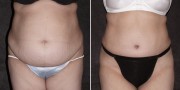 Dr. Kao Tummy Tuck (Abdominoplasty)