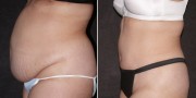 Dr. Kao Tummy Tuck (Abdominoplasty)