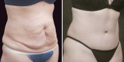 Dr. Kao Tummy Tuck (Abdominoplasty)