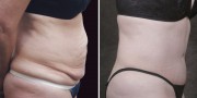 Dr. Kao Tummy Tuck (Abdominoplasty)