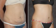 Dr. Kao Tummy Tuck (Abdominoplasty)