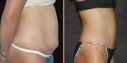 Dr. Kao Tummy Tuck (Abdominoplasty)