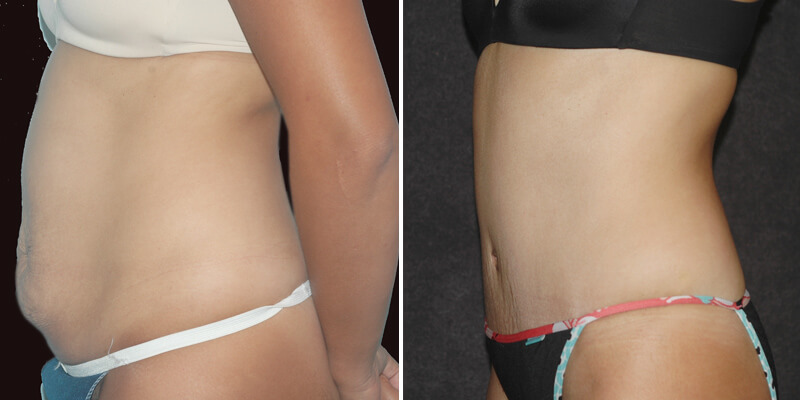 Dr. Kao Tummy Tuck (Abdominoplasty)