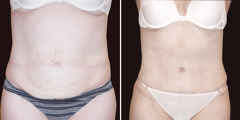 Dr. Kao Tummy Tuck (Abdominoplasty)