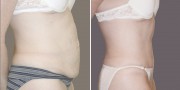 Dr. Kao Tummy Tuck (Abdominoplasty)