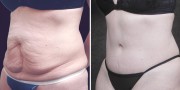 Dr. Kao Tummy Tuck (Abdominoplasty)