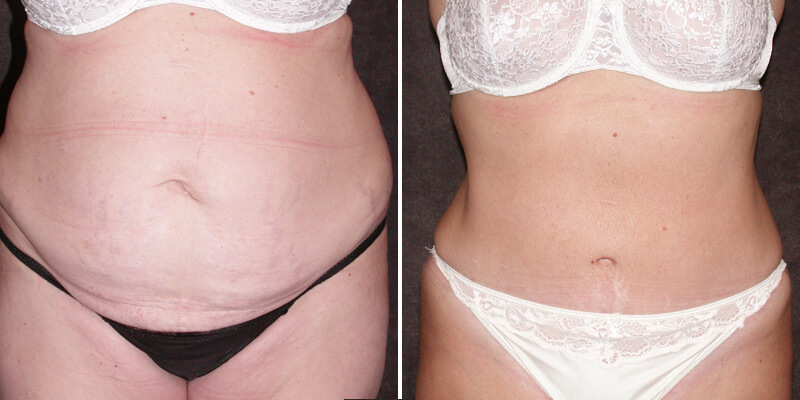 Dr. Kao Tummy Tuck (Abdominoplasty)