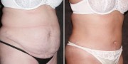 Dr. Kao Tummy Tuck (Abdominoplasty)