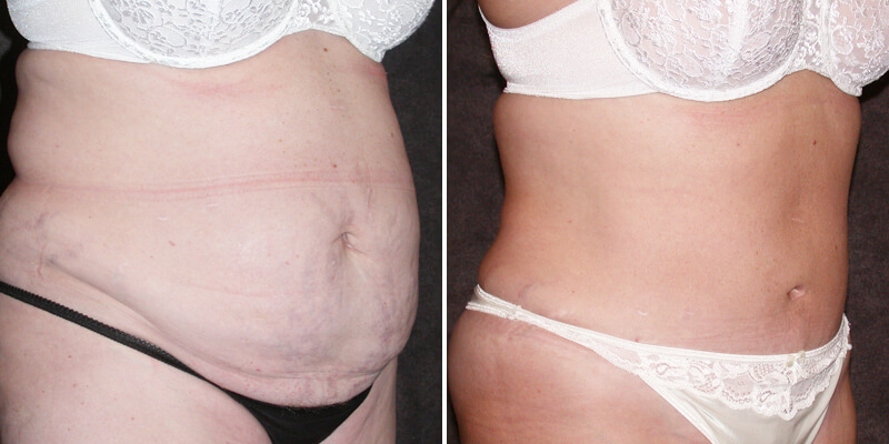 Dr. Kao Tummy Tuck (Abdominoplasty)