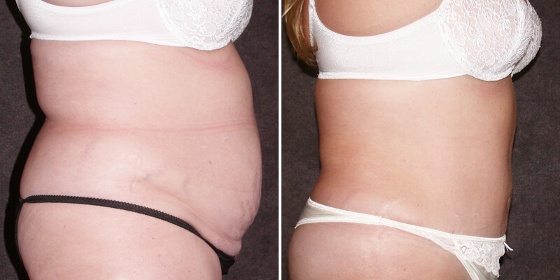 Dr. Kao Tummy Tuck (Abdominoplasty)