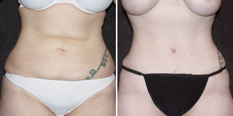 Dr. Kao Tummy Tuck (Abdominoplasty)