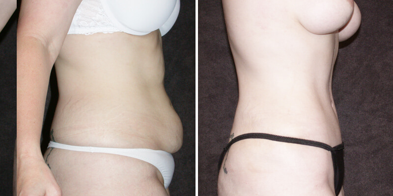 Dr. Kao Tummy Tuck (Abdominoplasty)