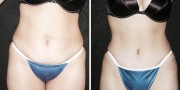 Dr. Kao Tummy Tuck (Abdominoplasty)