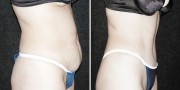 Dr. Kao Tummy Tuck (Abdominoplasty)