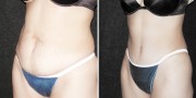 Dr. Kao Tummy Tuck (Abdominoplasty)