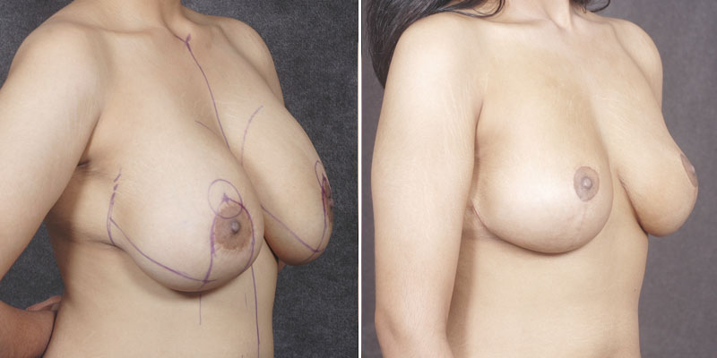 Dr. Kao Breast Lift with Implants