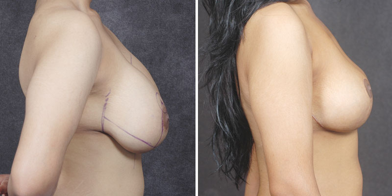 Dr. Kao Breast Lift with Implants