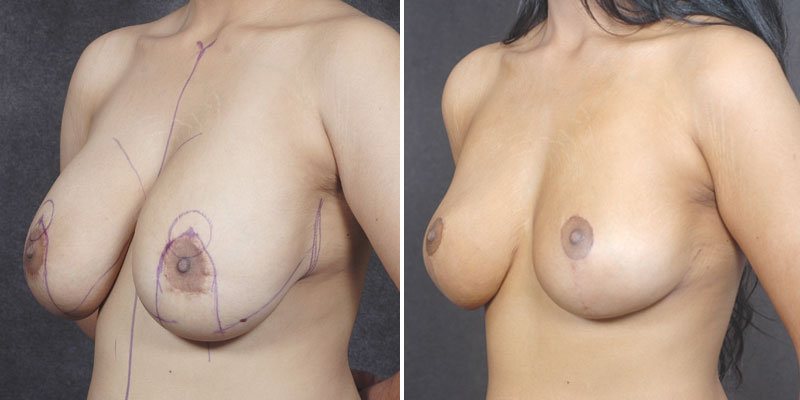 Dr. Kao Breast Lift with Implants