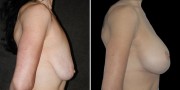 Dr. Kao Breast Lift with Implants