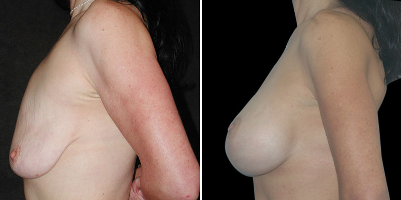 Dr. Kao Breast Lift with Implants