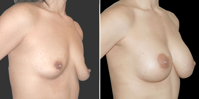 Dr. Kao Breast Lift with Implants